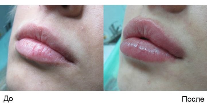 Увеличение губ гиалуроновой кислотой - фото до и после
